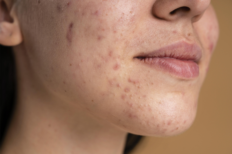 Marcas de acne