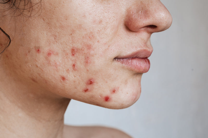 Acne e espinhas