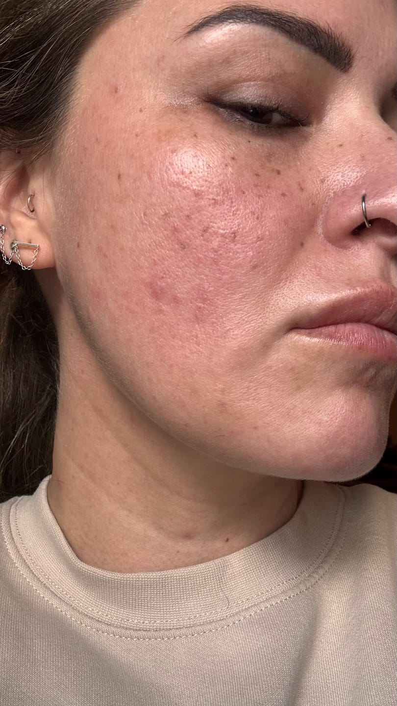 Pele com acne e oleosidade