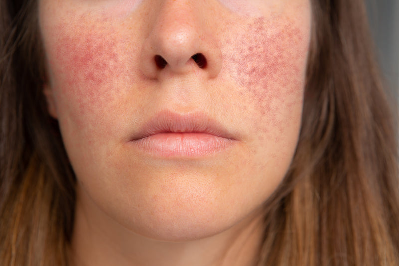 Vermelhidão e Inflamação